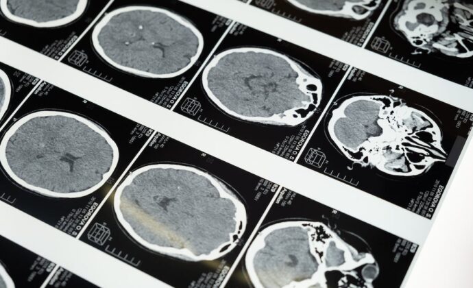 Rows of transparent brain MRI images